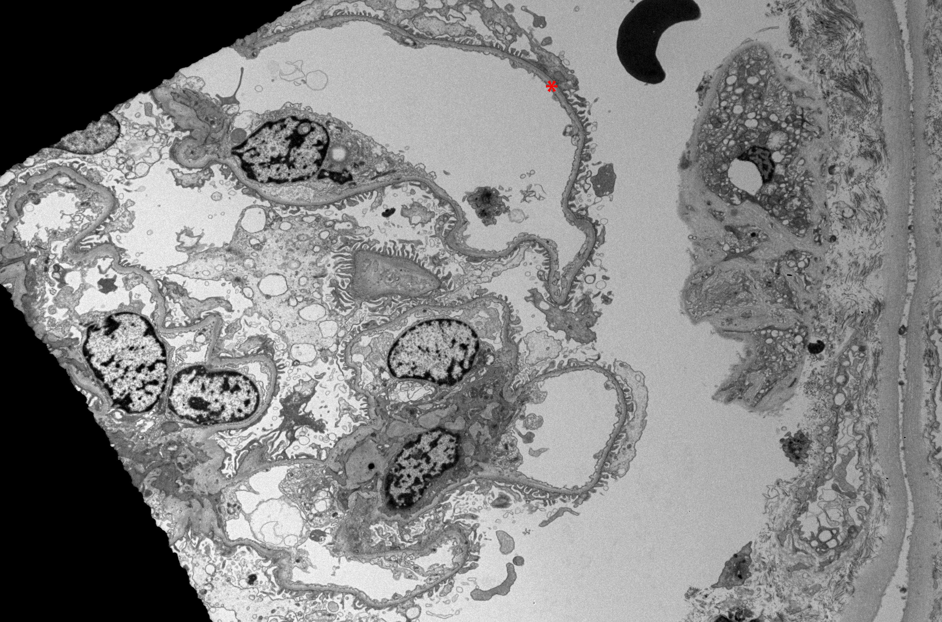 <p>Electron Microscopy of Renal Parenchyma in Thin Basement Membrane Nephropathy