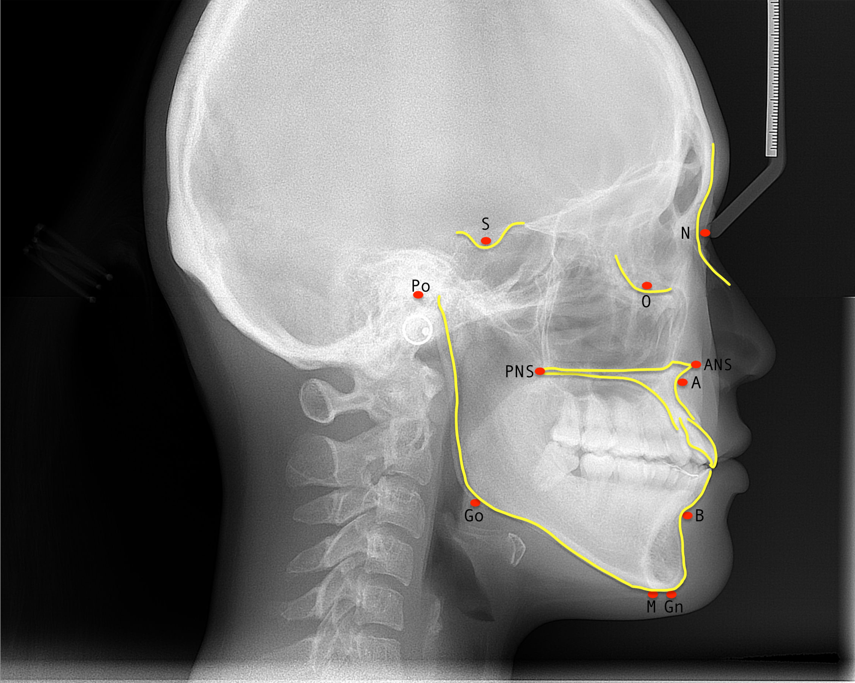 <p>Common Cephalometric Points.</p>