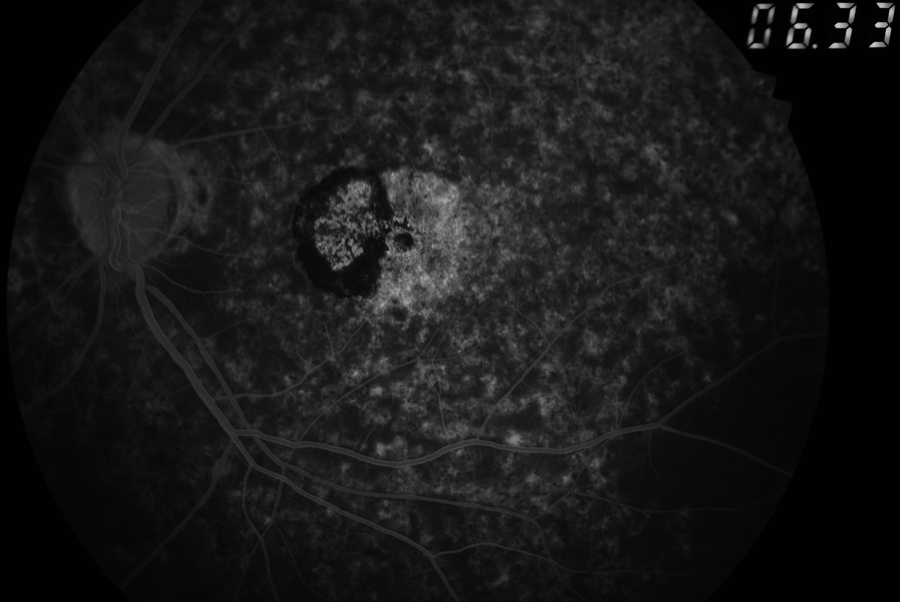 <p>Silent Choroid in Fluorescein Angiogram