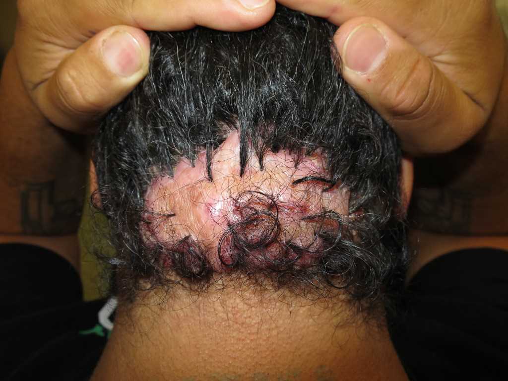 <p>Folliculitis Keloidalis</p>