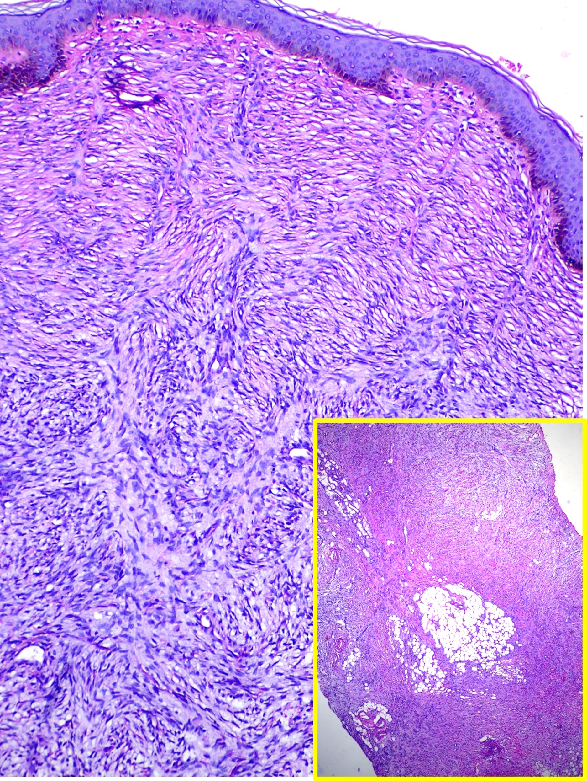 <p>Hematoxylin and Eosin Stain Dermatofibrosarcoma Protuberans