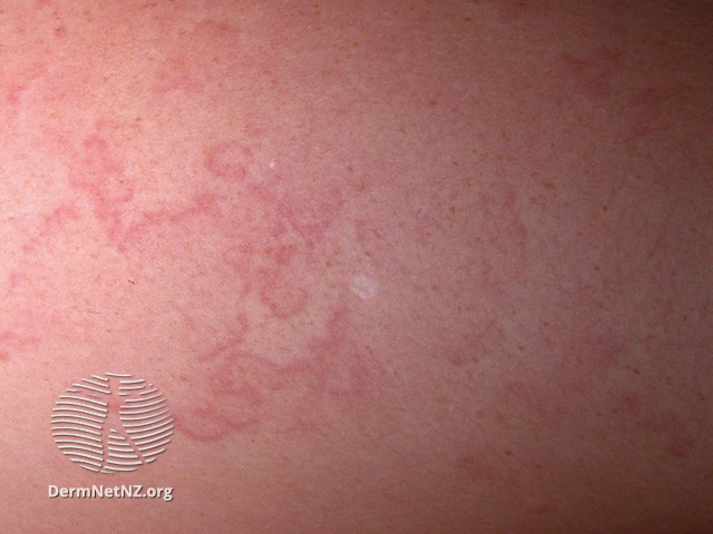 <p>Erythema Marginatum</p>