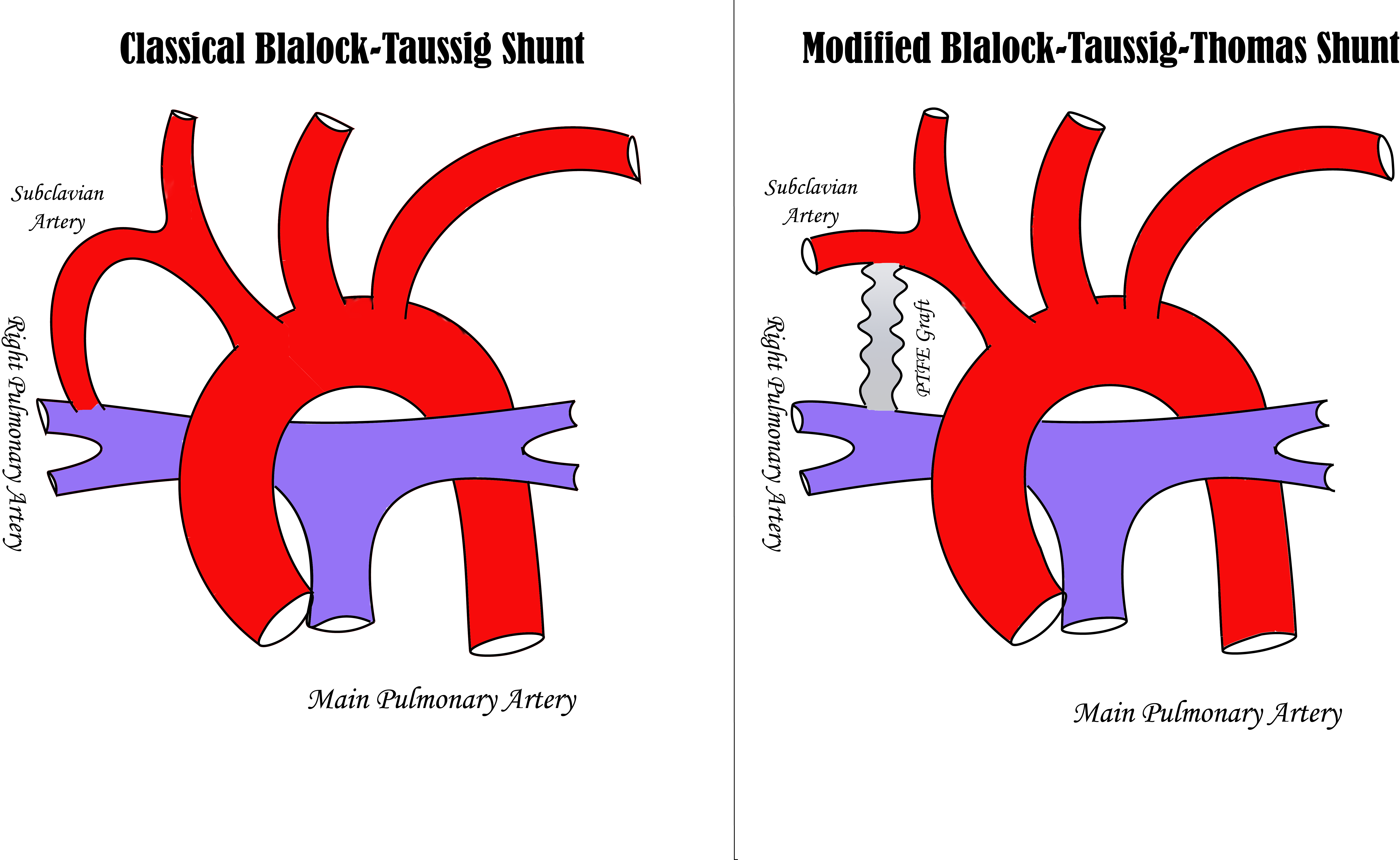 <p>Comparison of Classical Blalock-Taussig and Modified Blalock-Taussig-Thomas Shunts