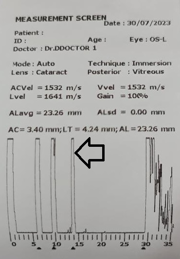 <p>Ultrasound Biometry Printout. A printout of&nbsp;ultrasound&nbsp;biometry&nbsp;(immersion).</p>