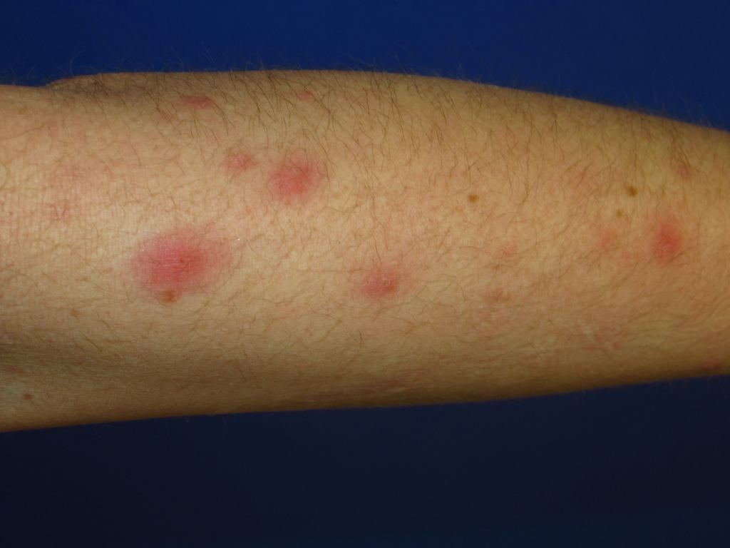 <p>Folliculitis</p>