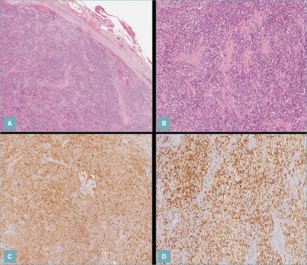 <p>Host-Pathological Examination, Orbital Solitary Fibrous Tumors