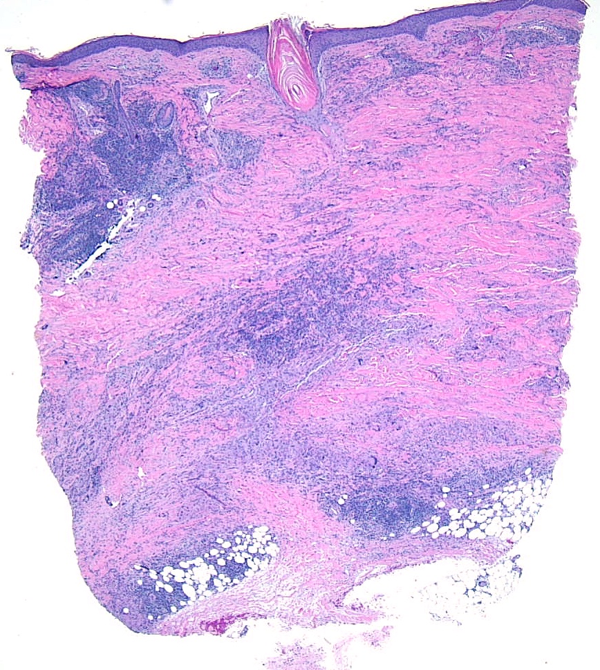 <p>Pathological Findings of Necrobiosis Lipoidica: Skin Biopsy</p>