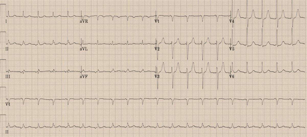 <p>Narrow Complex Tachycardia With Prolonged RP Interval