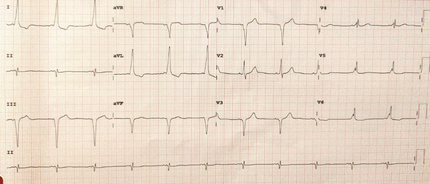 <p>Sinus Rhythm With Short PR Interval and Delta Wave