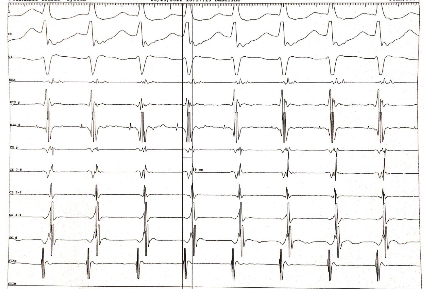 <p>Narrow Complex Tachycardia: Short Ventriculoatrial Interval