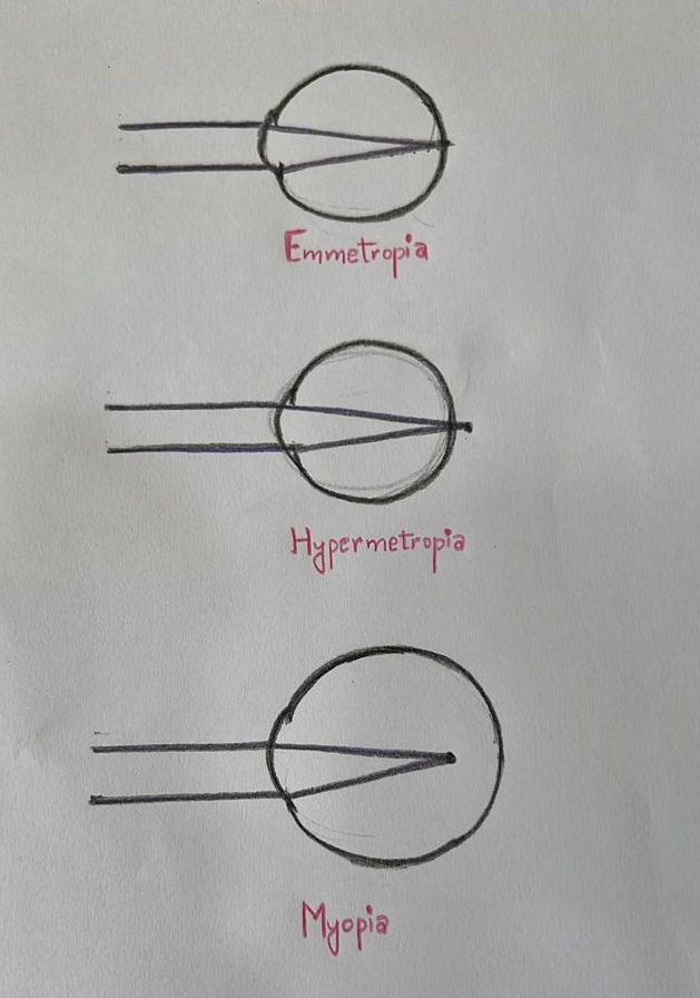 <p>Refractive Conditions Ray Diagram