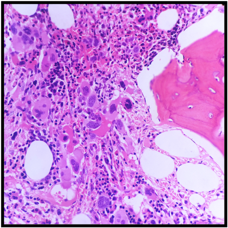 <p>Primary Myelofibrosis