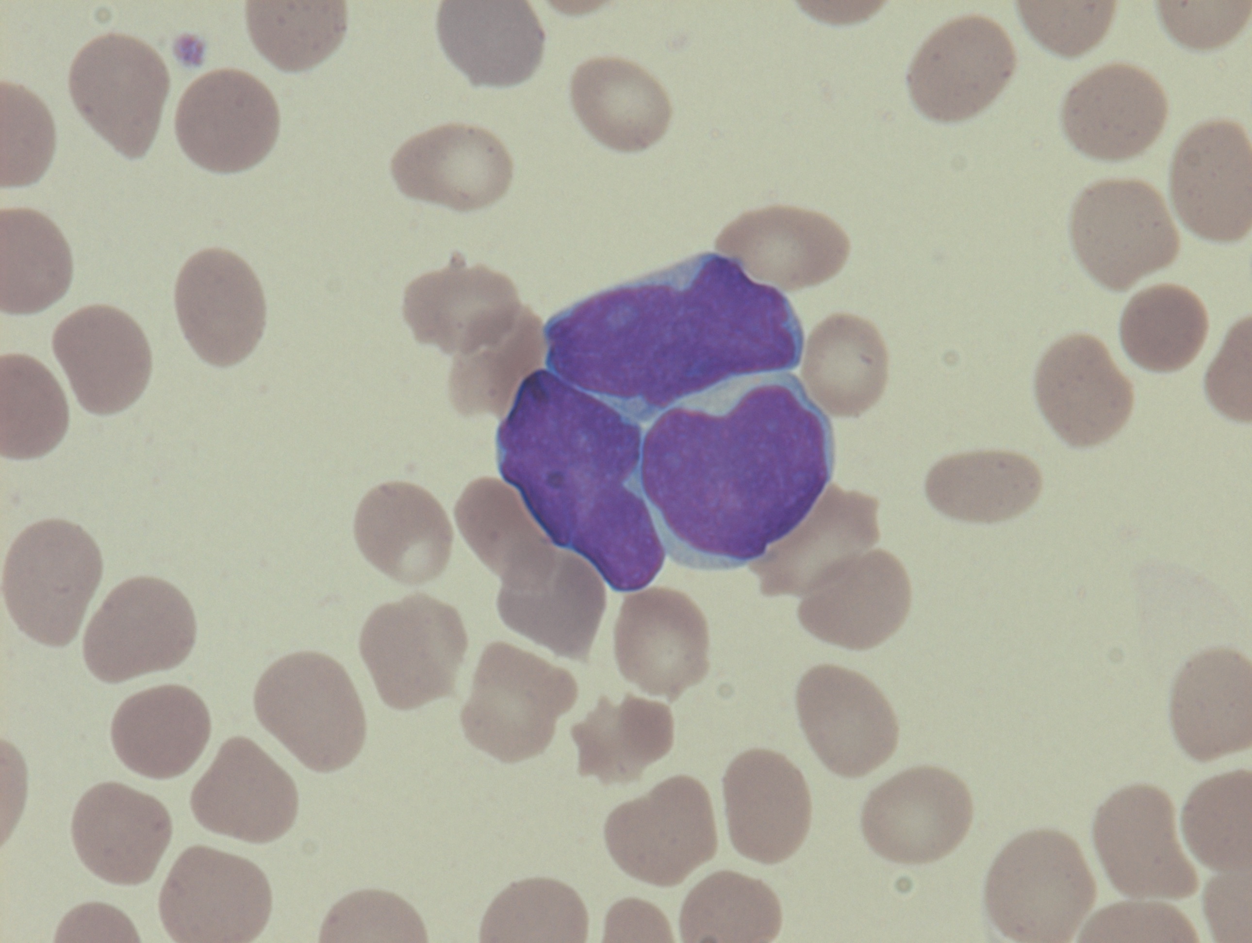 <p>Bone Marrow Aspirate with Blasts