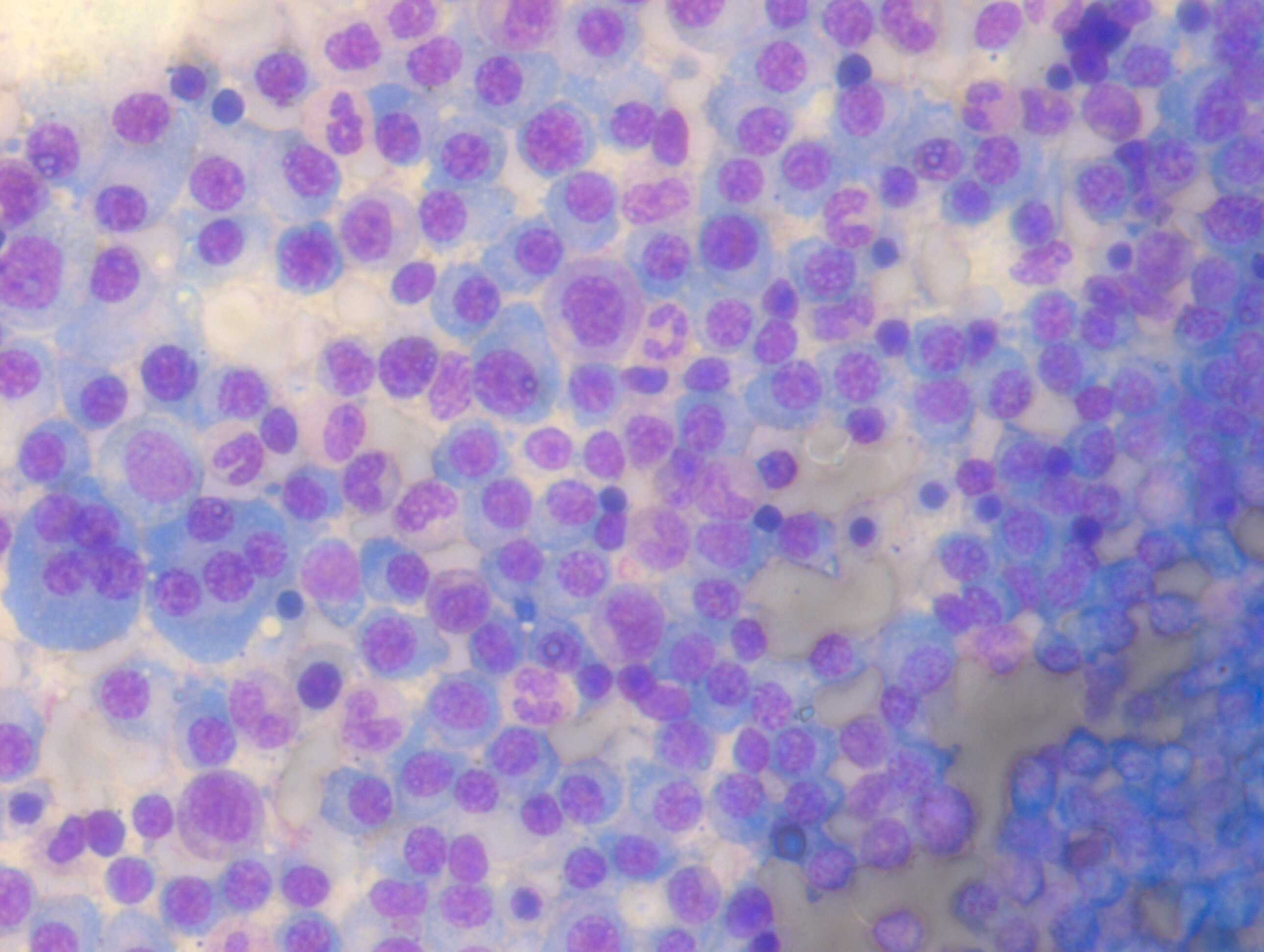 <p>Bone Marrow Aspirate with Plasma Cells