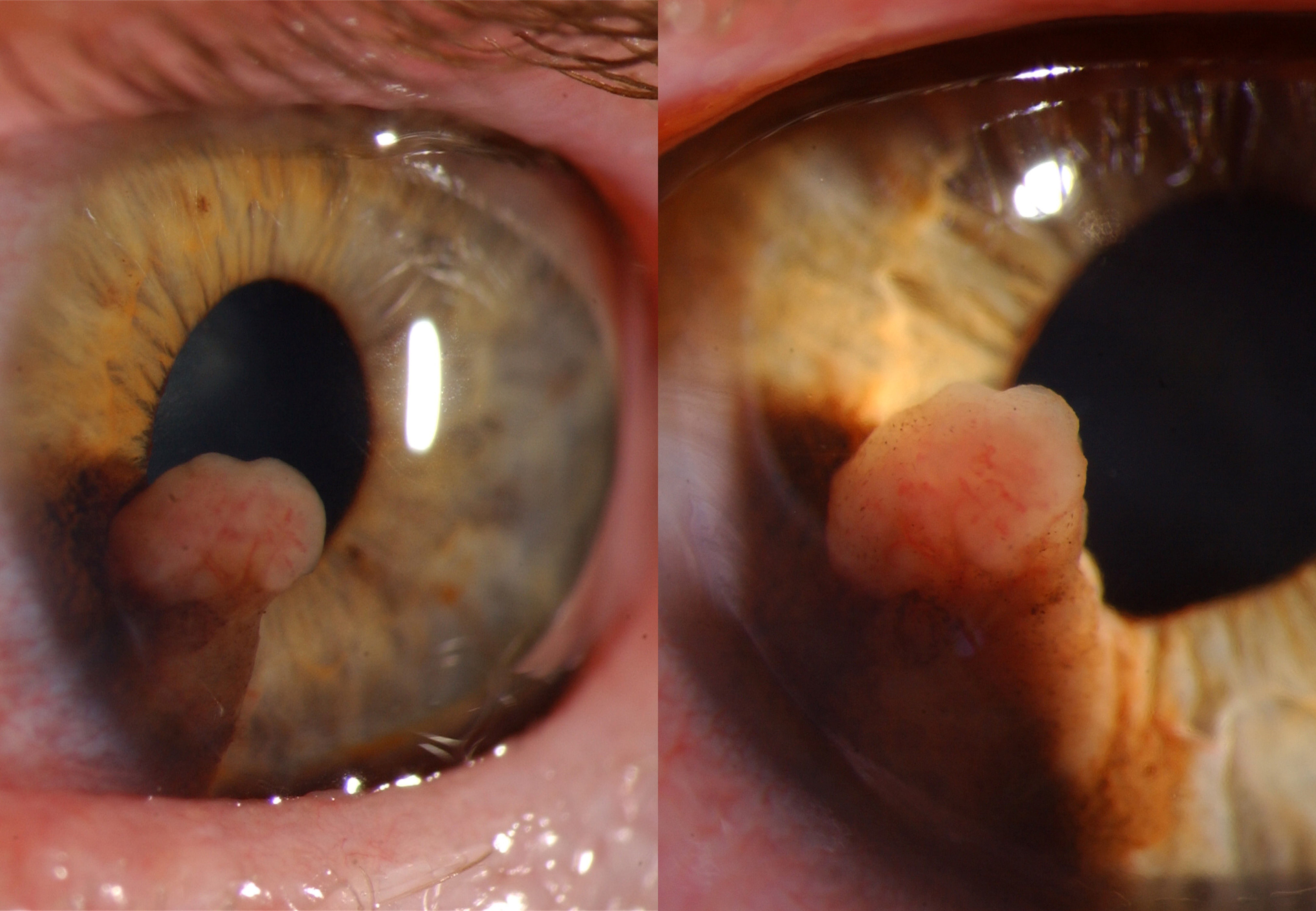 <p>Malignant Melanoma of Iris. Malignant melanoma of the iris with more amelanotic and vascular appearance.</p>