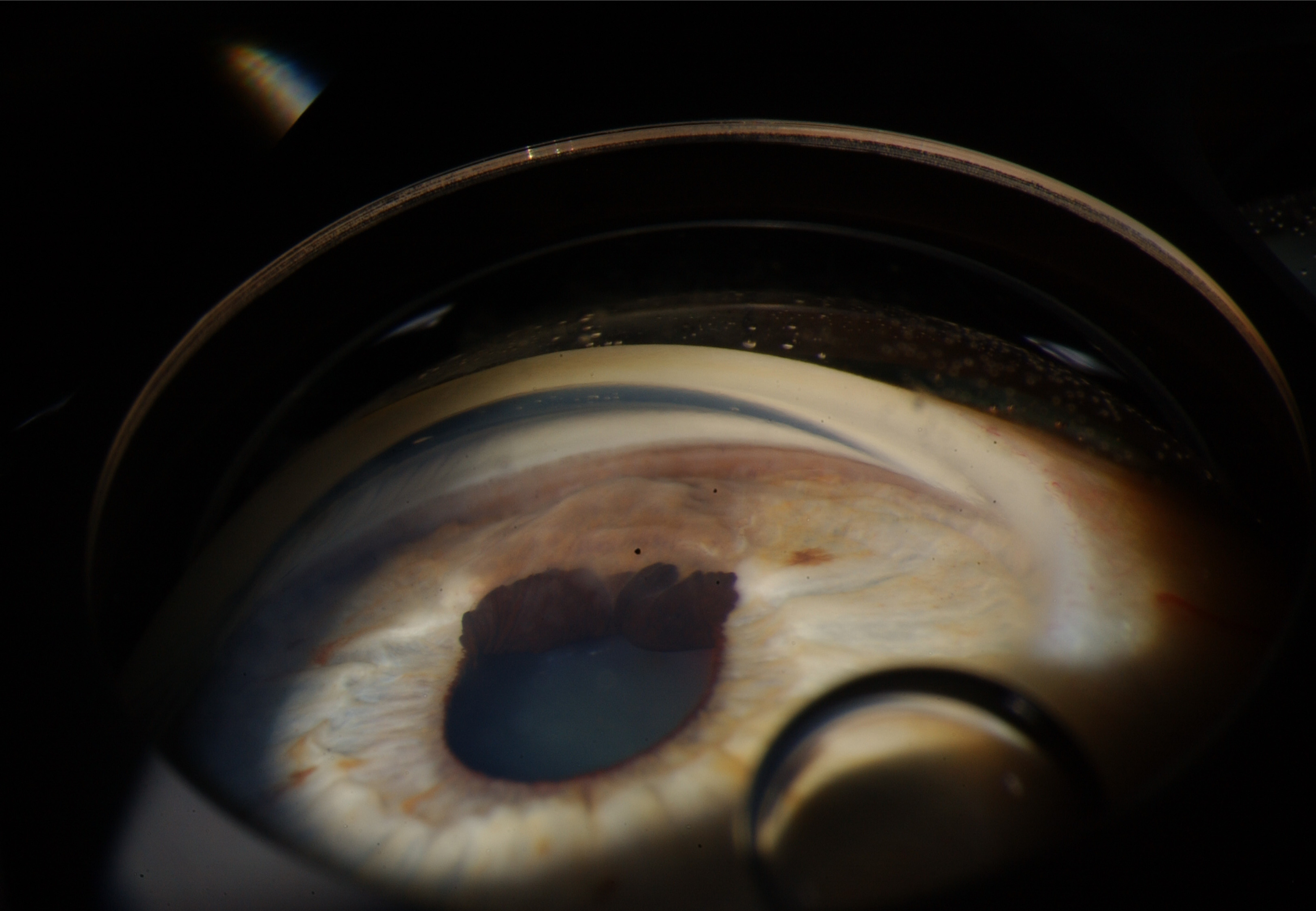 <p>Malignant Melanoma of Iris Typical Presentation. Malignant melanoma of the iris with typical melanotic presentation.</p>