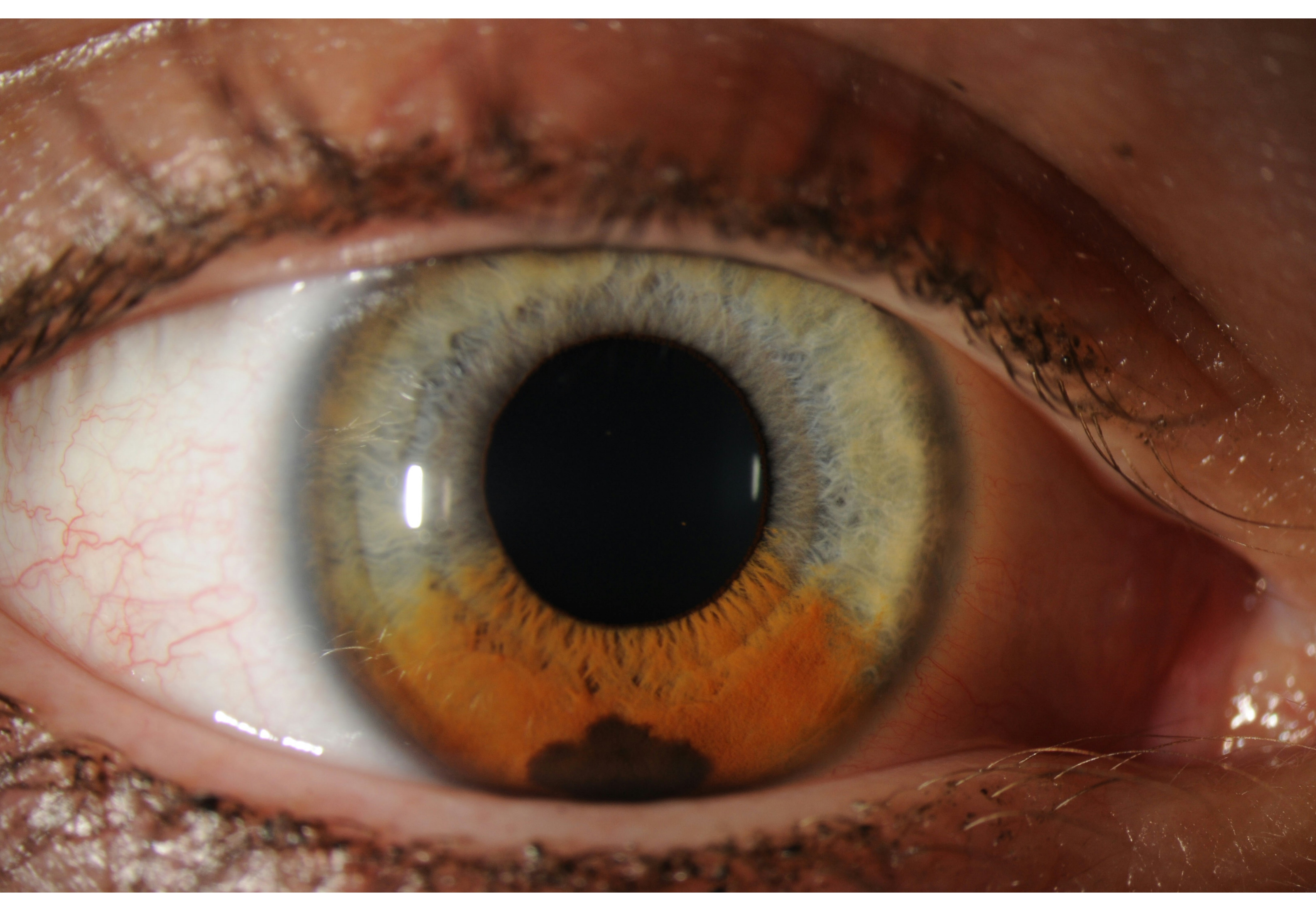 <p>Iris Nevus. Iris nevus with surrounding discoloration.</p>