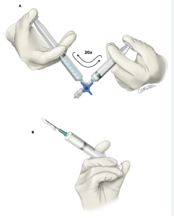 Schematic of Tessari Technique