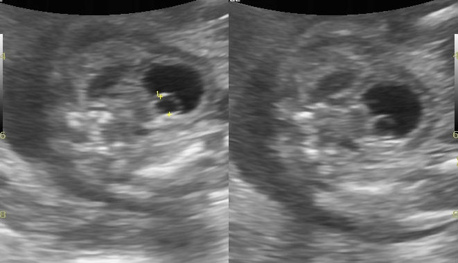 <p>Antenatal Ultrasound&nbsp;of&nbsp;Fetal Ureterocele</p>