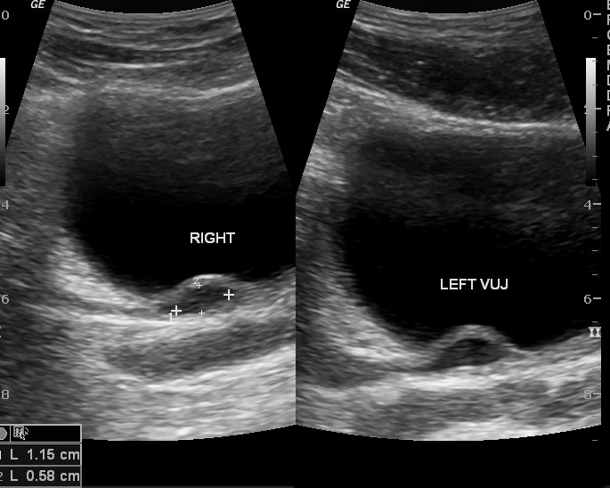 <p>Ultrasound of Bilateral Ureteroceles</p>