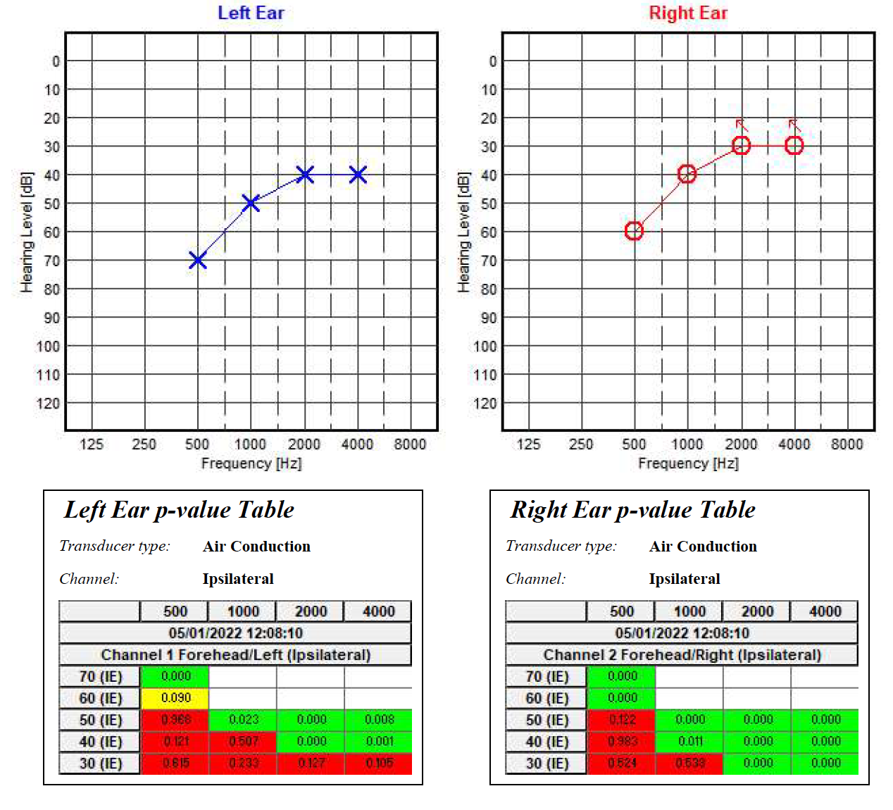 <p>Audiogram. Auditory steady-state response examination using MASTER application.</p>