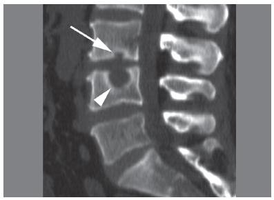 <p>CT, Schmorl Nodes