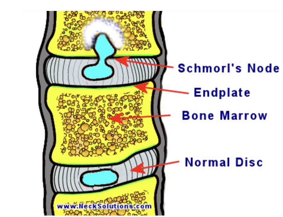 Schmorl Node Illustration