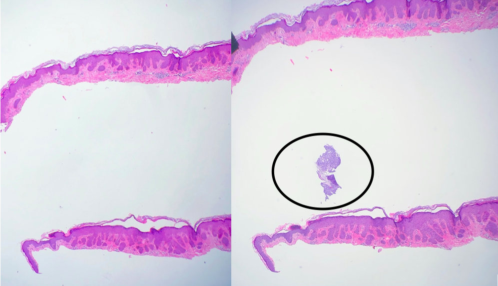 <p>Floater Artifact. Basal cell carcinoma floater only in one section.</p>