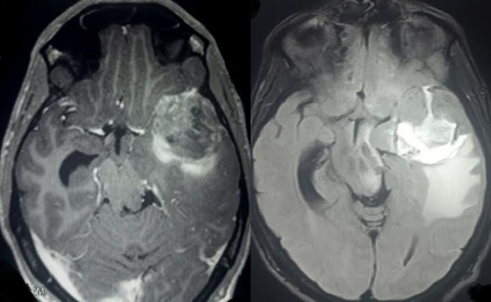 <p>Herpes Simplex Encephalitis. The area of hyperintensity is indicative of inflammation due to encephalitis.</p>