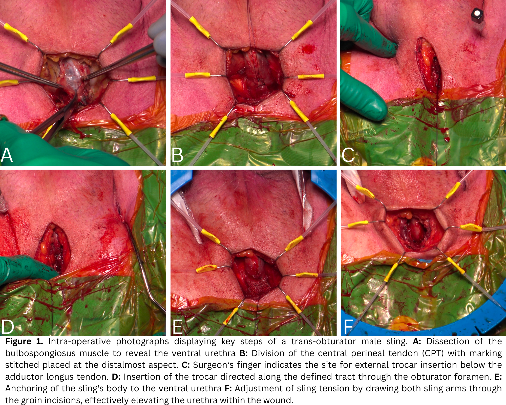 <p>Transobturator Male Sling Insertion</p>