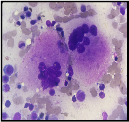 <p>Dysplastic Megakaryocytes, Hyperlobated