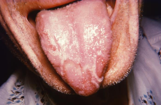 <p>Benign Migratory Glossitis