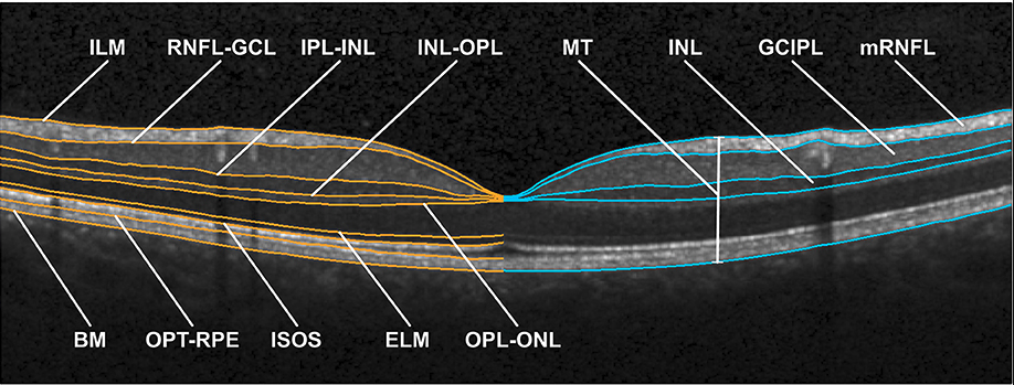 <p>Optical Coherence Tomography