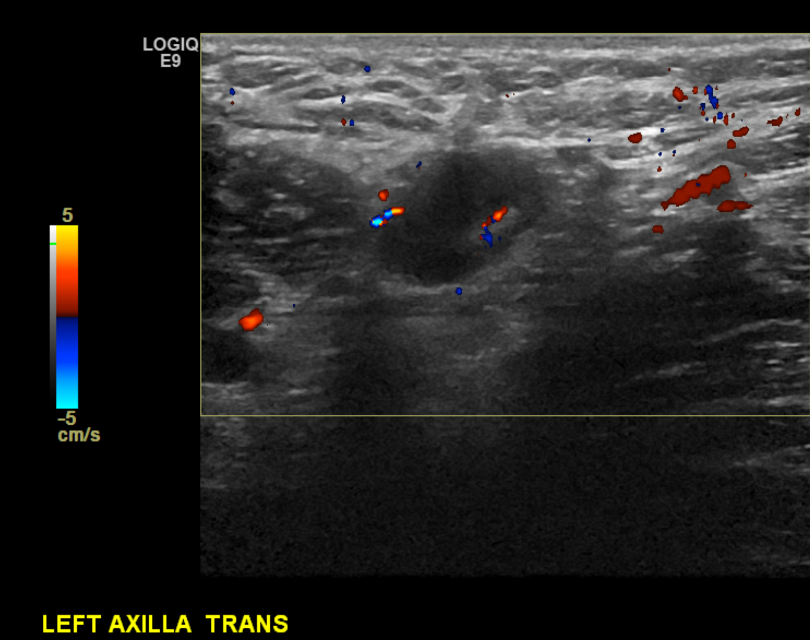 Biopsy proven malignant left axillary lymph node with cortical thickening of 5 mm