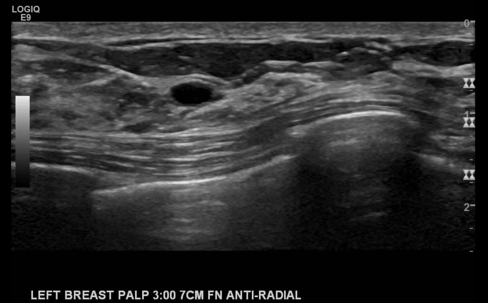 Simple cyst of the left breast.