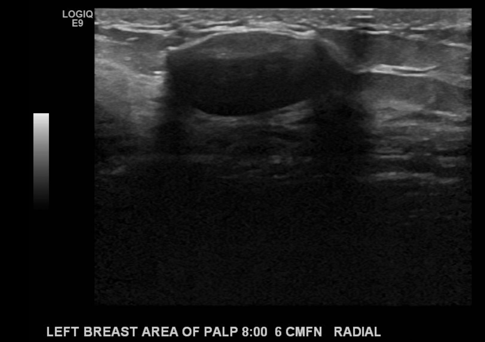 Findings demonstrating an oval, parallel, circumscribed, hypoechoic mass with no discernable posterior features