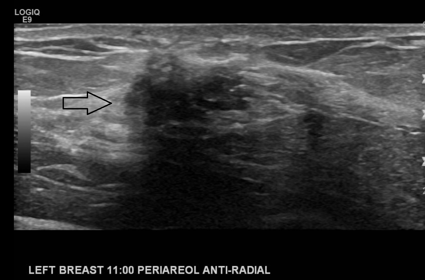 Biopsy proven atypical ductal hyperplasia