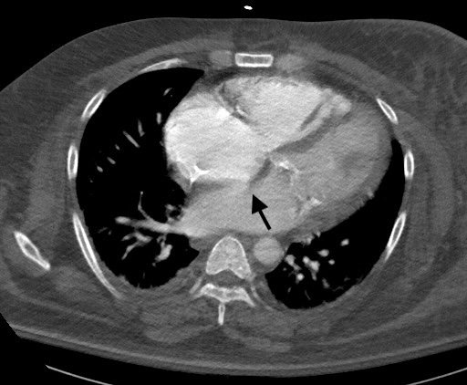 Patent Foramen Ovale Computed Tomography