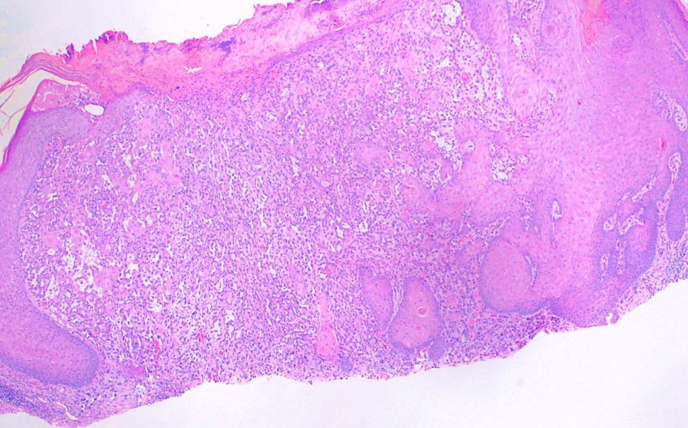 <p>Histological Slide of Squamous Cell Carcinoma, Acantholytic