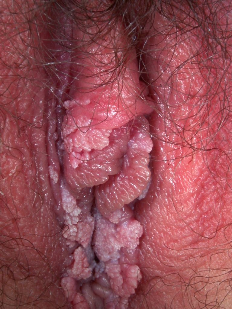 Genital Warts, Female