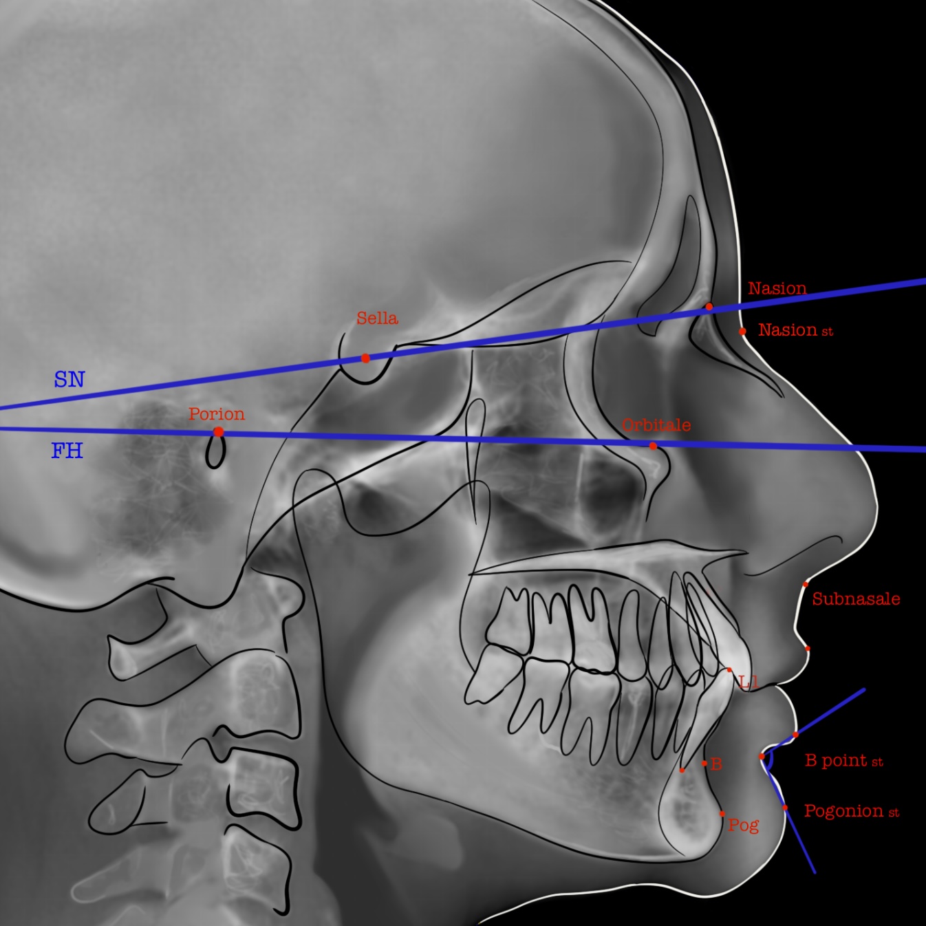 <p>Labiomental Angle