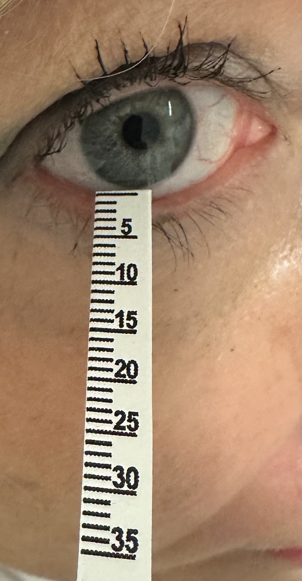 <p>Application of Schirmer Test Strip