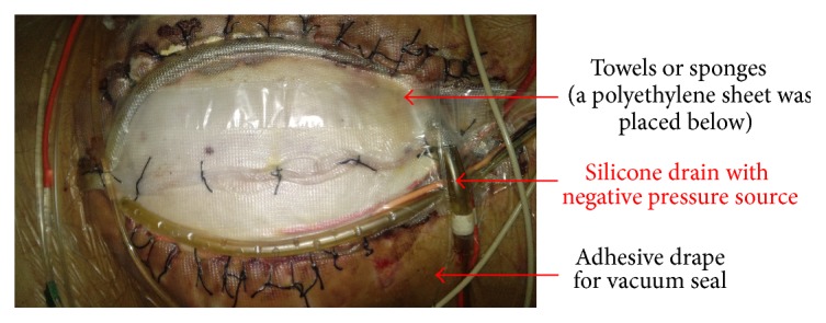 <p>Vacuum Pack Dressing. The component layers of the vacuum pack dressing that are used in temporary abdominal closure.</p>