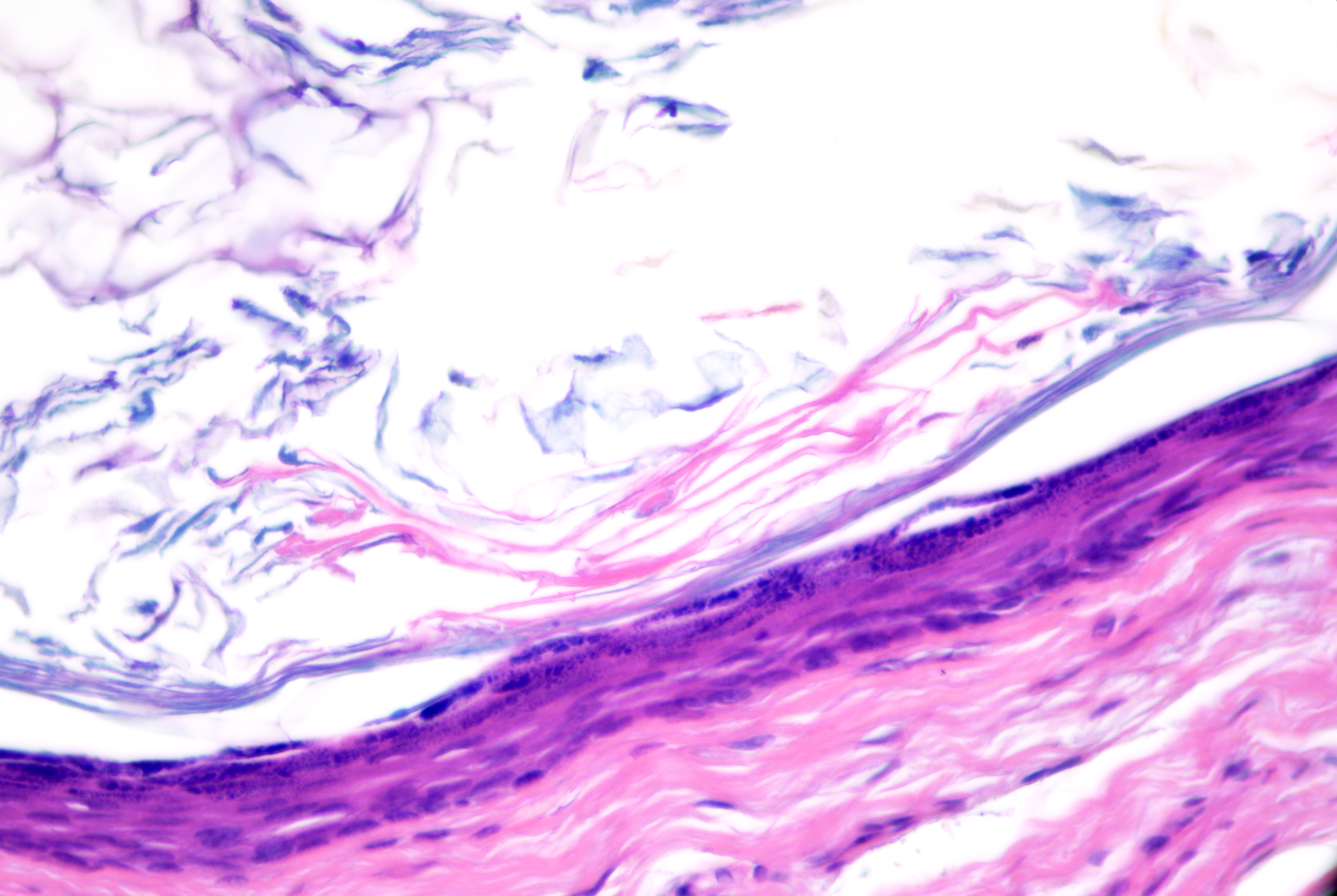 <p>Epidermoid Cyst Lining