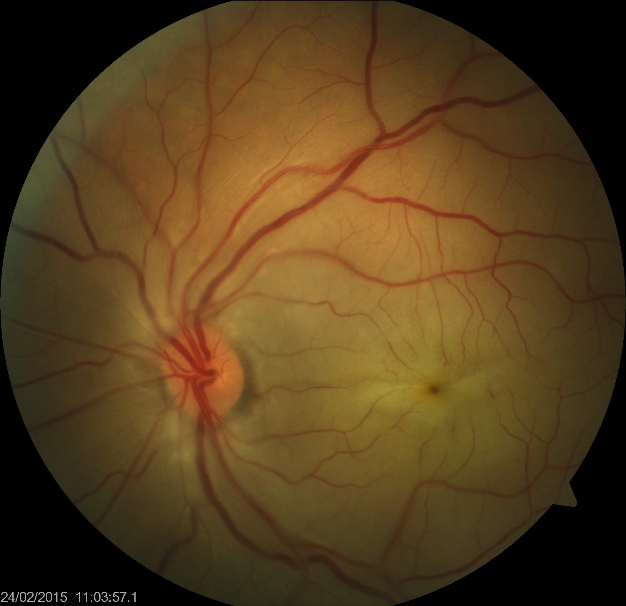 <p>Central Retinal Arterial Occlusion