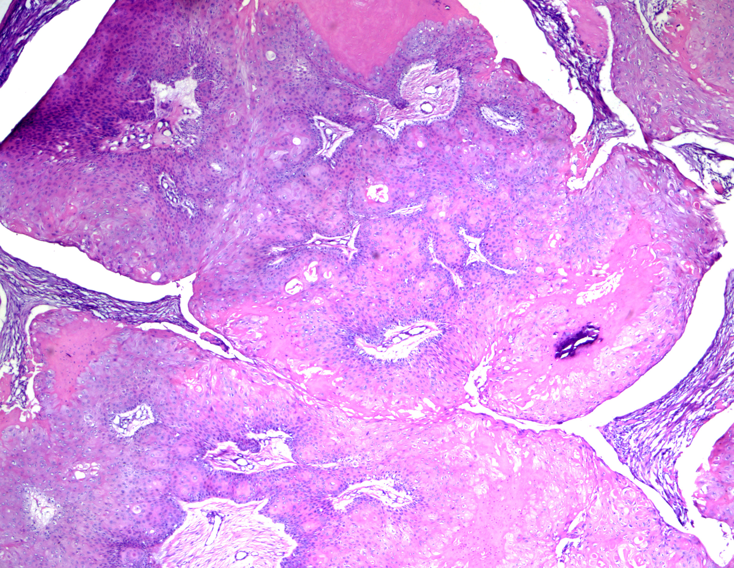 <p>Proliferating&nbsp;Pilar Tumor