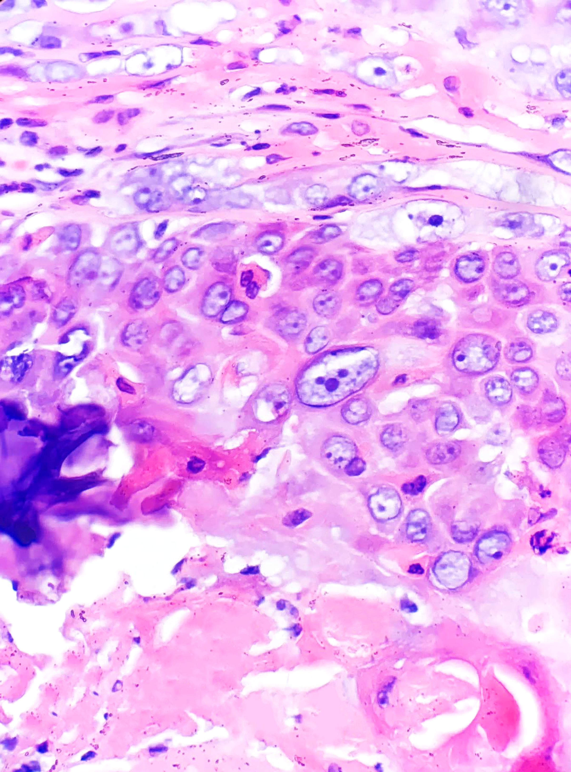 <p>Proliferating Trichilemmal Tumor