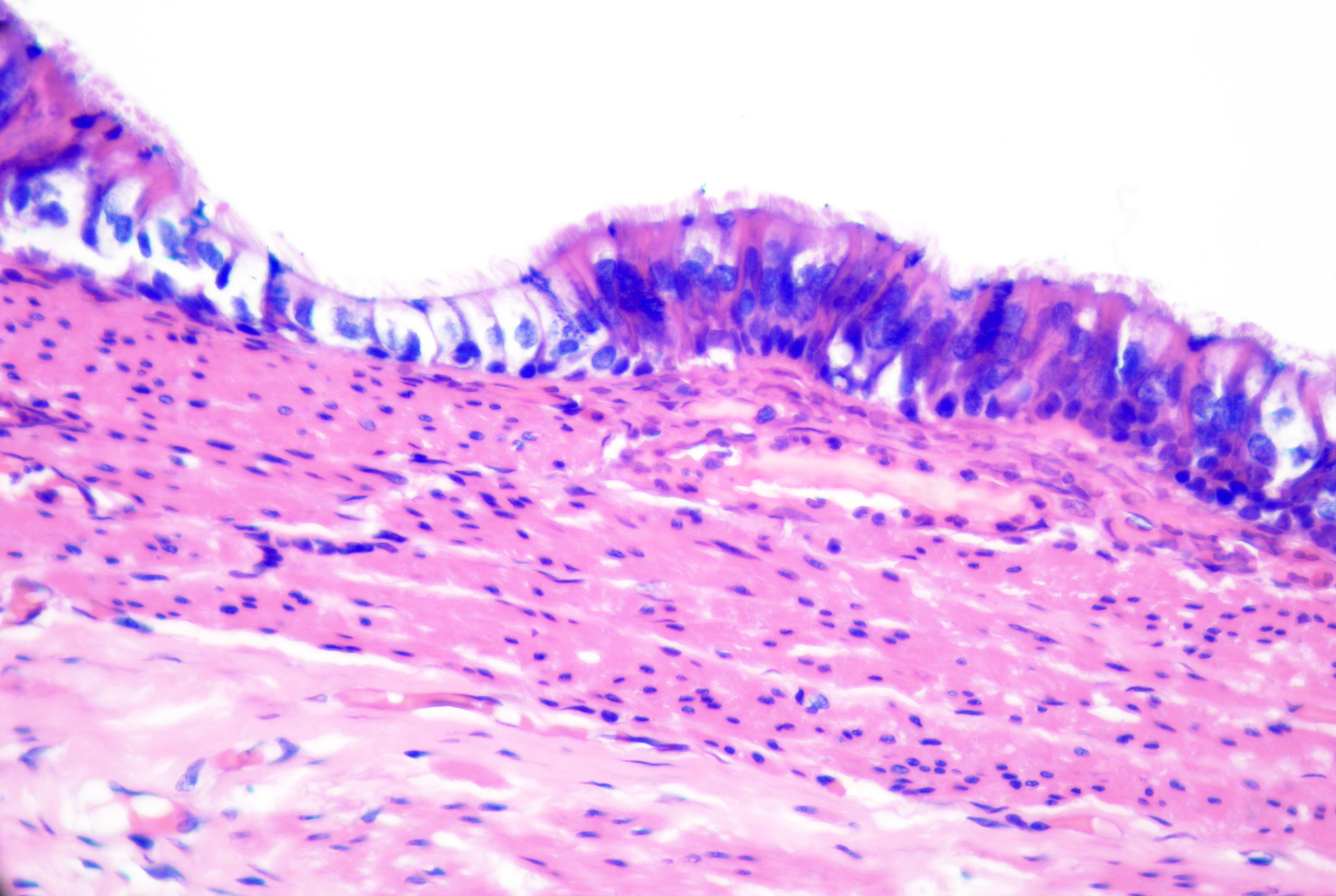 <p>Bronchogenic Cyst