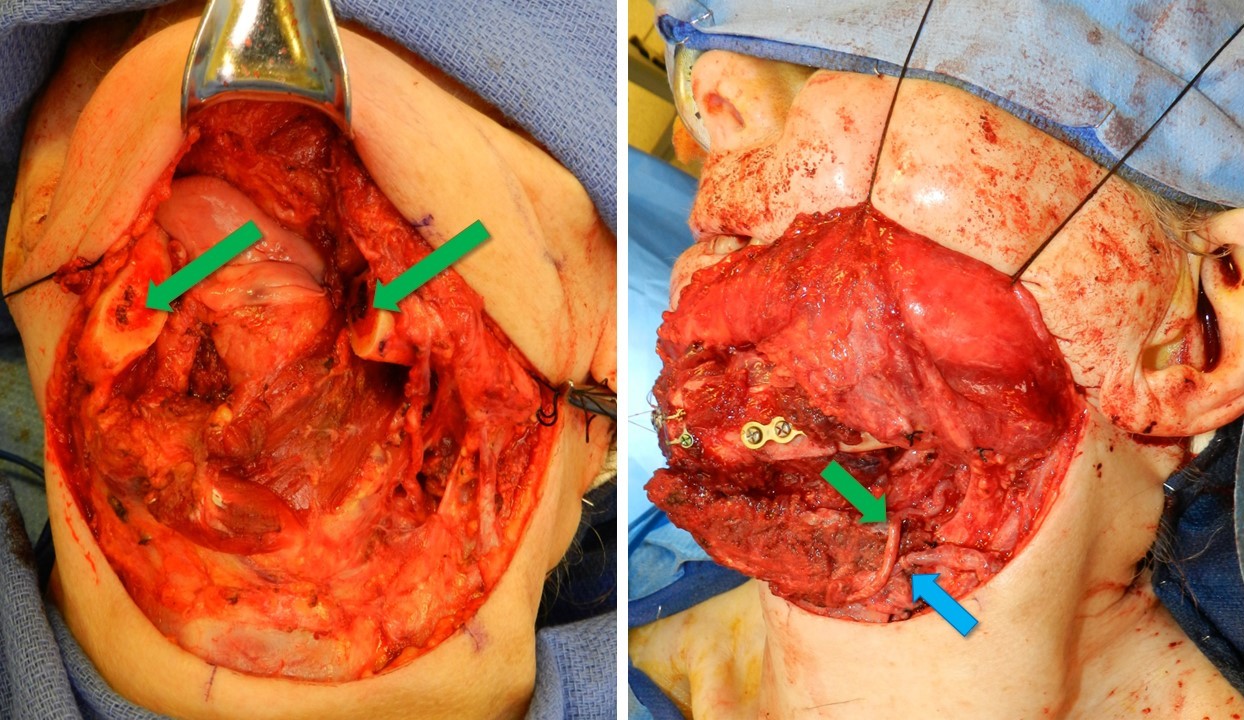 <p>Resected Mandible and Fibula Free Flap Placement