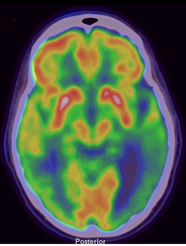 <p>F18 FDG PET/CT Brain Scan